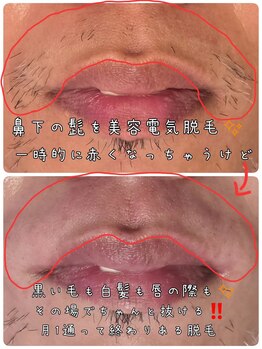 ベビースキン(baby skin)/美容電気脱毛