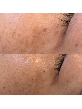 アール(ar.)/シミケアフェイシャル