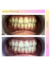 エクシアホワイトフジ(ecxia white fuji)/ホワイトニングサロン　富士市