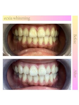 エクシアホワイトフジ(ecxia white fuji)/ホワイトニングサロン 富士市