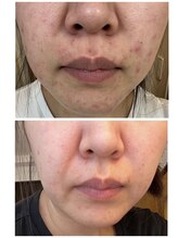 ヨサパーク リアン(YOSA PARK Lien)/モニター様before→after