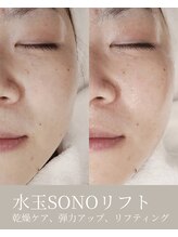 エムネ ラボ 大阪本町(M/NE &nbsp;LAB)/水玉SONOリフティング