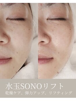 エムネ ラボ 大阪本町(M/NE LAB)/水玉SONOリフティング