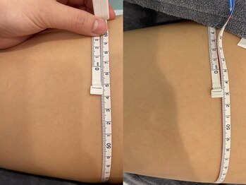 リメイク 銀座(REMAKE)/脂肪冷却