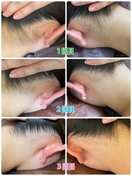 ゼロ 水戸店(ZERO)/うなじ脱毛★before&after