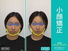 美骨矯正 ステキプロ(SUTEKI pro)/小顔矯正・輪郭整顔矯正