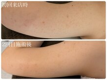 ブリエ(Briller)/二の腕のハーブピーリング