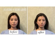 ヤマモト 表参道院(YAMAMOTO)/美容鍼＋筋膜調整