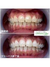 ホワイトニングサロン 名古屋駅店/【ホワイトニング施術例】
