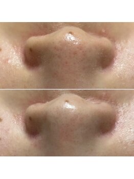 ノーブル 上土店(Noble)/毛穴洗浄BeforeAfter