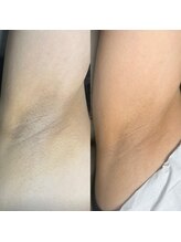 ローマピンク 札幌/脇の黒ずみもRomaPink