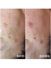 イーズ(eees)/シミケア施術直後