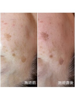 イーズ(eees)/シミケア施術直後