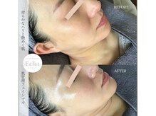 変化率No.1のサロンケア"ACトリートメント"別人級の素肌へ♪