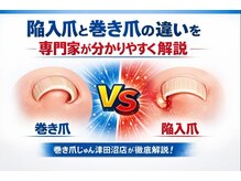 巻き爪じゅん 船橋店/陥入爪について専門家が解説