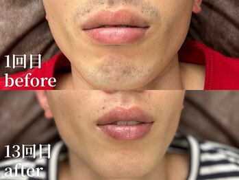 ボス 名古屋店(BOSS)/【ヒゲ脱毛　before & after】