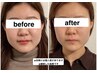 【目元周辺が気になる方へ】目元のたるみ、眼精疲労など目元特化美容鍼☆