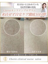 シェリー(Cherie)/施術なし！毛孔性苔癬改善