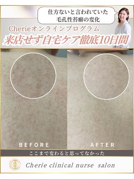 シェリー(Cherie)/施術なし！毛孔性苔癬改善