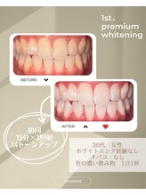 スリール(sourire)/プレミアムホワイトニング
