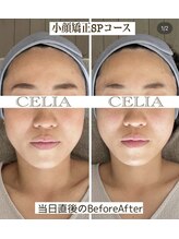 セリア(CELIA)/小顔矯正/小顔