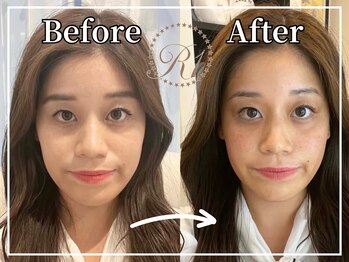 R-1ビューティーサロン 銀座/BEFORE＆AFTER　５回目