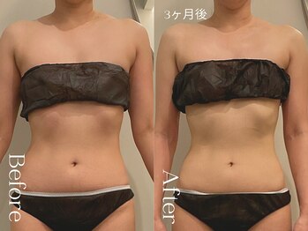 ユーフォリア グロウ(euphoria glow)/{ ラフォス90分×EMS15回 }