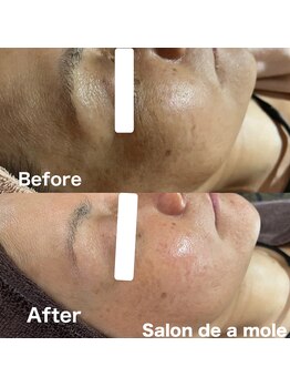 サロンドアモール(Salon de a mole)/ハーバルシー症例写真／シミ