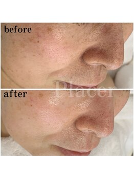 プラセル(Placer)/くすみもスッキリ