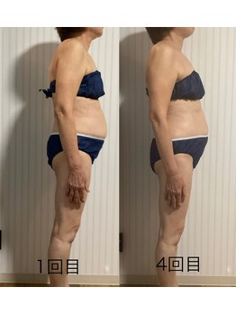 オリス(ORRIS)/ビフォーアフター(姿勢改善)