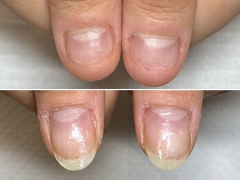 グラシュータン(gracieux temps)/【深爪矯正13000円】