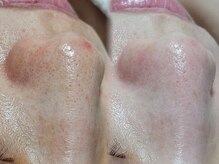 エスポワール(ESPOIR)/毛穴特化フェイシャルピーリング