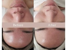 プシュケ(Psyche)/お客様の肌変化