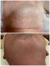 ティアレ 廿日市店(Tiare)/髭脱毛　ひげ