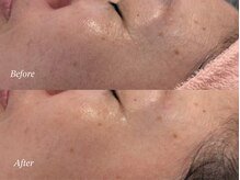 カレンジェビューティー(CarengeBeauty)/目尻のシワ改善