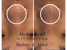 トウキョウビューティーラボ(TOKYO BEAUTY LABO.)/ハイドラBefore&After