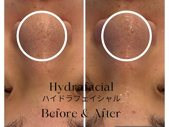 トウキョウビューティーラボ(TOKYO BEAUTY LABO.)/ハイドラBefore&After