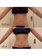 ソエルテ(soerute)/最新キャビテーション