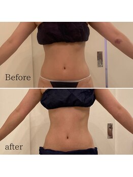 ソエルテ(soerute)/最新キャビテーション