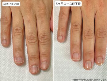 カピリナ(Ka Pilina)/自爪育成・川崎・深爪