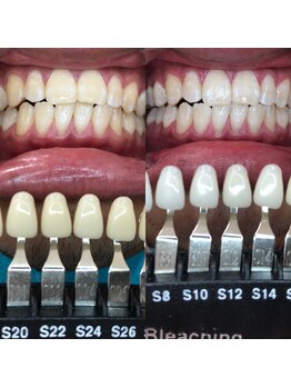 トウキョースワーズ 渋谷店(TOKYO SWRS)/#ホワイトニング #渋谷 #池袋