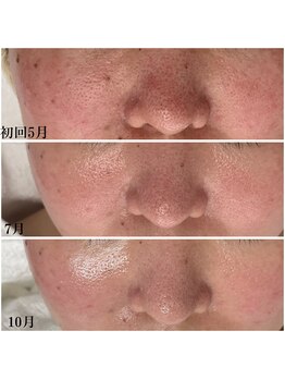 プラセル(Placer)/増やすより辞めていく