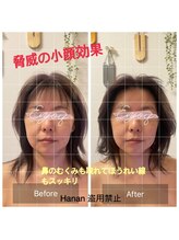 ハナン(Hanan)/ナノカレントで即日小顔に！