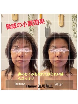 ハナン(Hanan)/ナノカレントで即日小顔に!