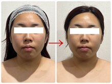 エクラ(e'clat)/全顔リフトアップ