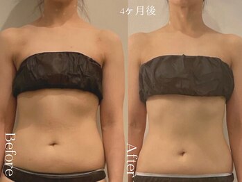 ユーフォリア グロウ(euphoria glow)/{ ラフォス痩身90分 24回 }