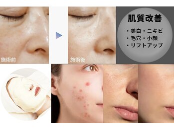 クレール グラン エステ/肌質改善