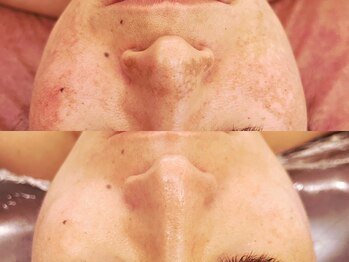 エステ ラミ(Esthe' l'ami)/プラズマ＋陶肌トリートメント