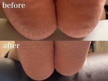 ベティ(Betty)/足裏角質ケアPEDiNET