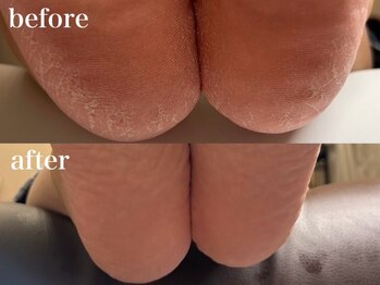 ベティ(Betty)/足裏角質ケアPEDiNET